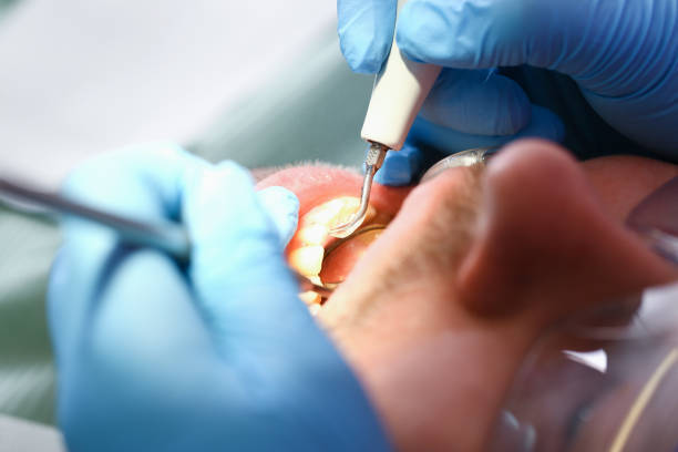 Best Emergency Root Canal Treatment in West Branch, IA